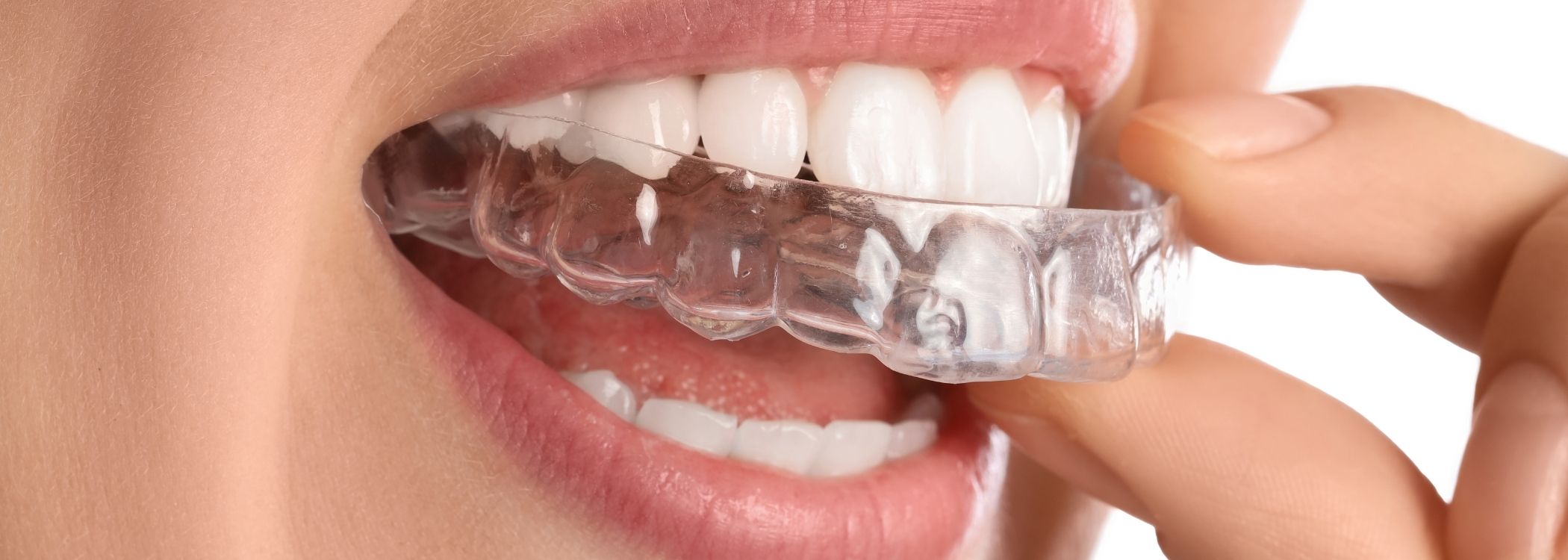 Aligner Transparan