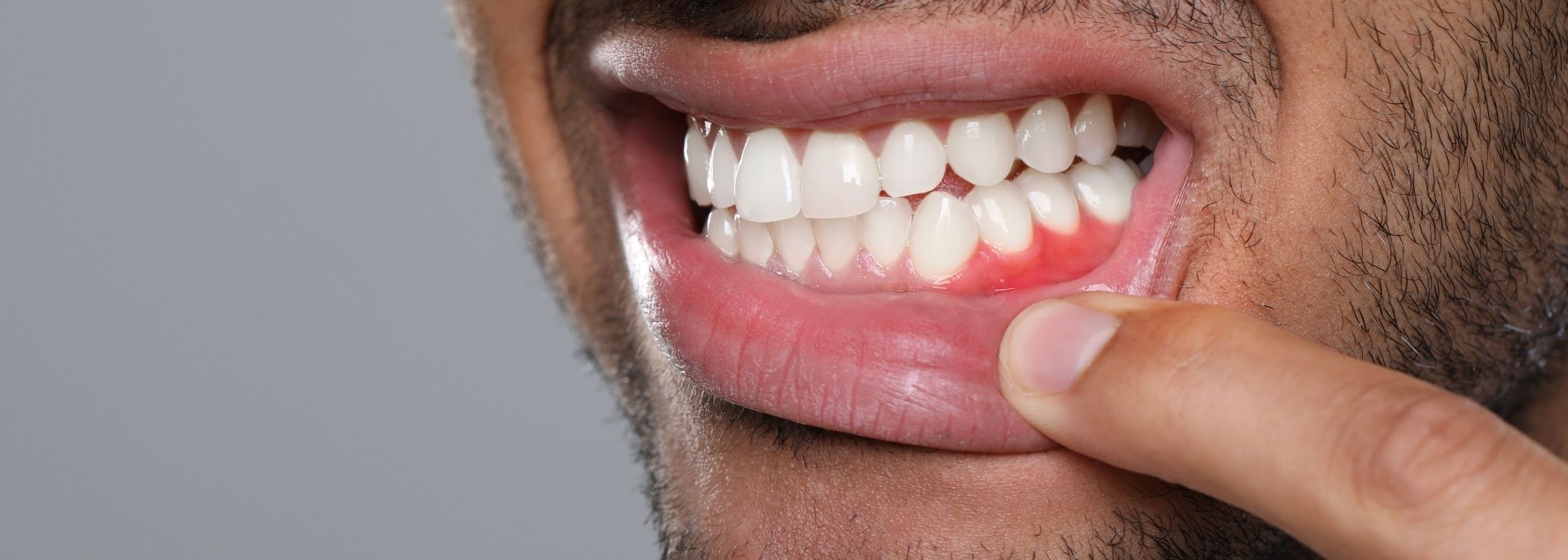Gingival Depigmentation