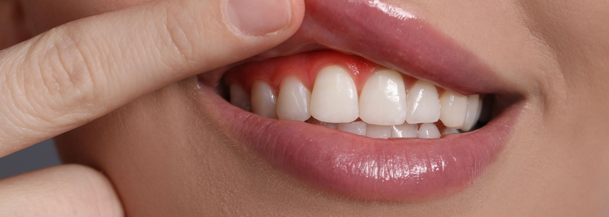 Gummy Lifting