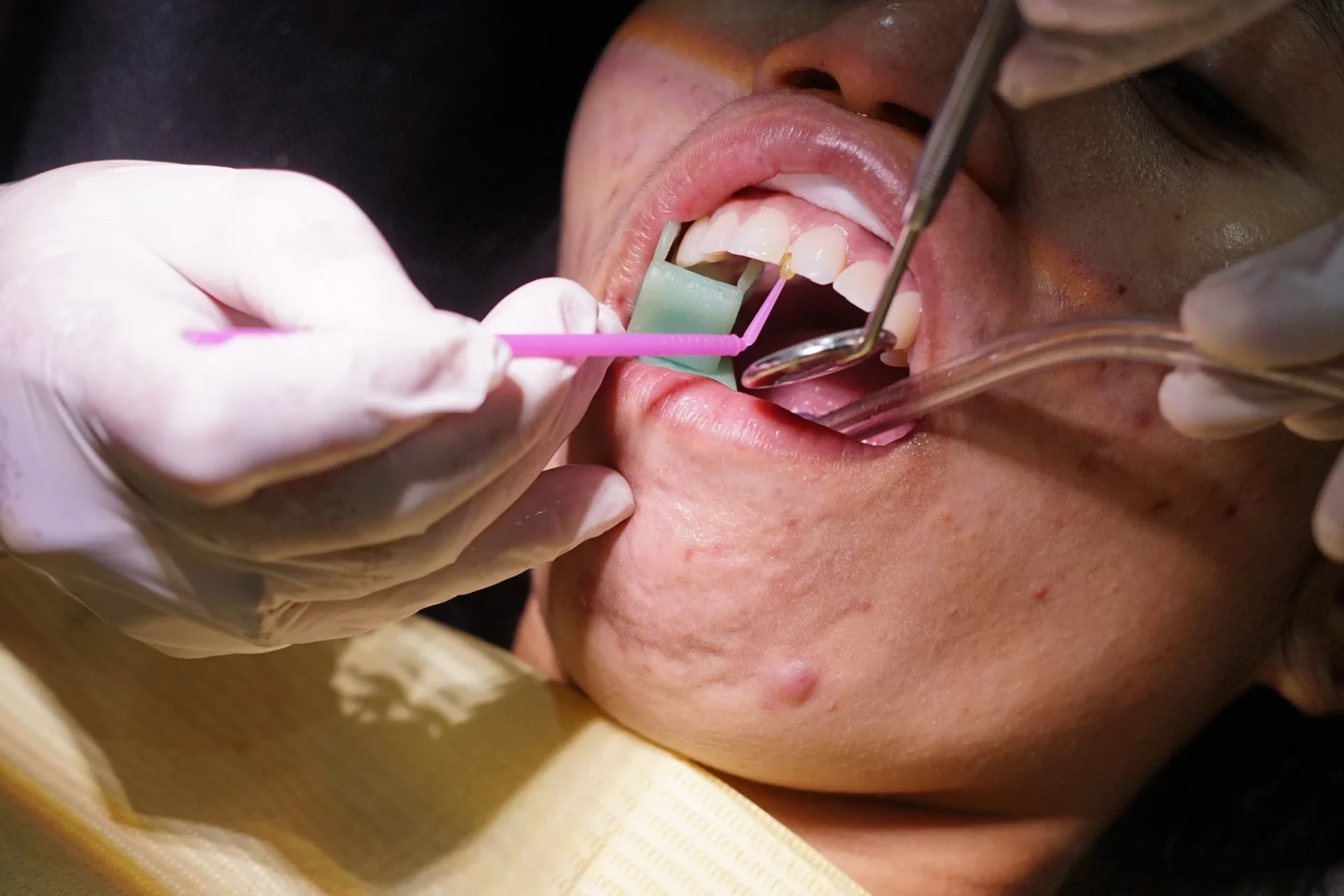 Gigi Berlubang Bisa Picu Sakit Jantung, Ini Penjelasannya