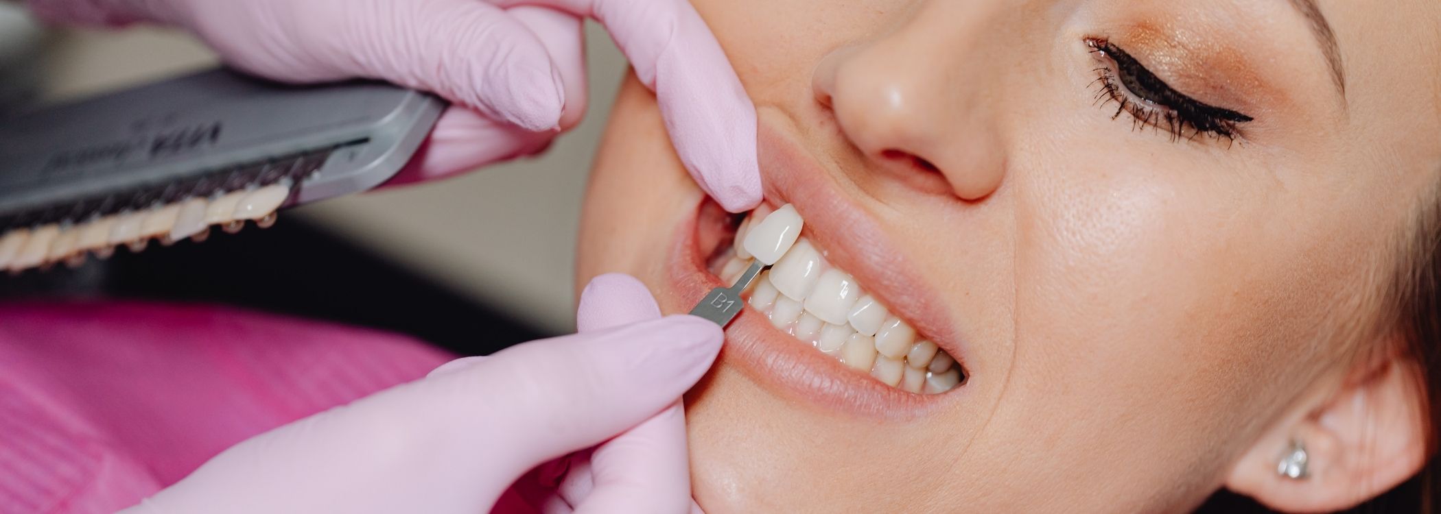 Veneer