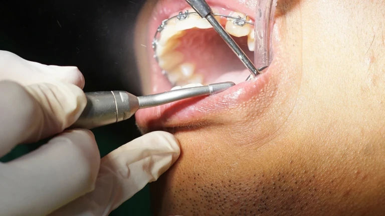 Promo Behel Gigi Cempaka Putih, Harga Lebih Ringan
